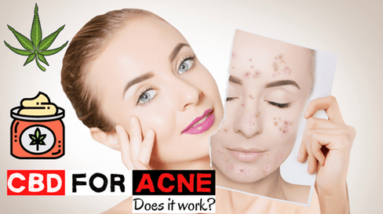 CBD for Acne – Does it Work