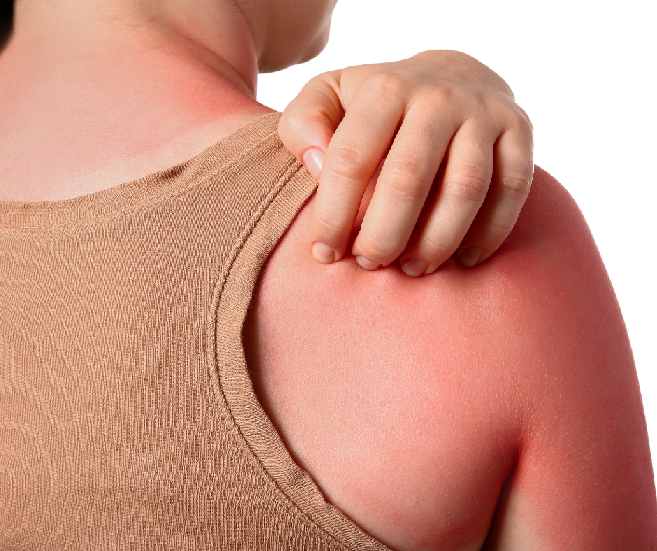 Does Hemp Lotion Help Sunburn